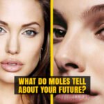 Moles on different Parts of Body