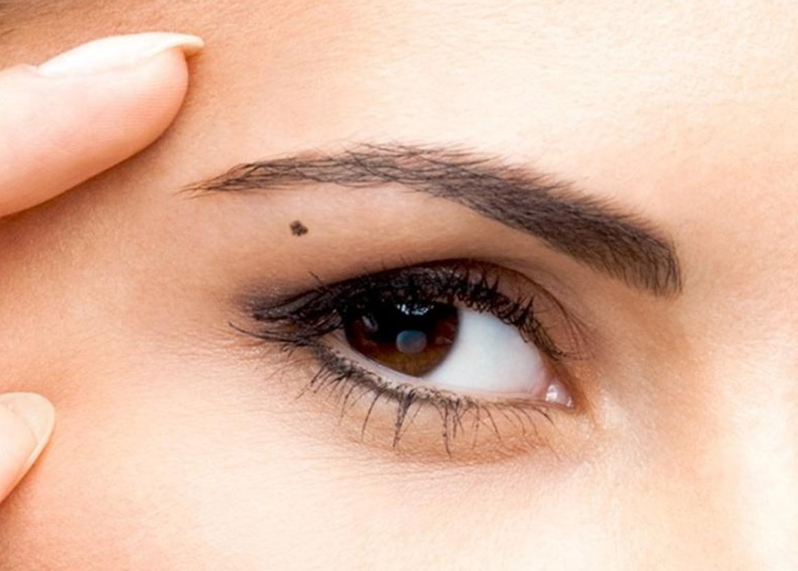 Mole Over Left Eyebrow